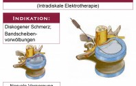 Intradiskale Elektrotherapie (IDET)